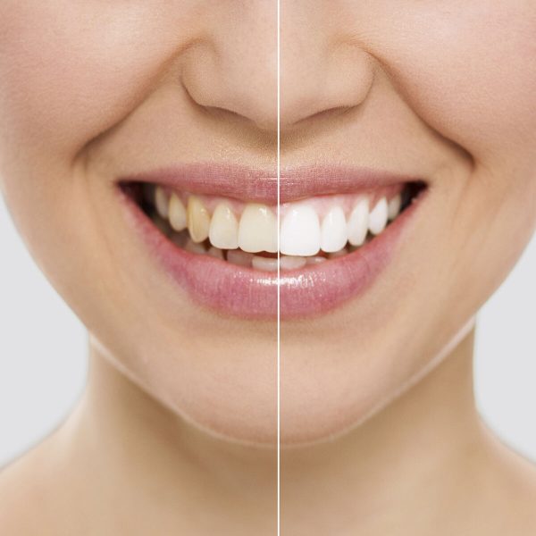 Teeth Whitening Strips Wripes InnovaGoods For Cheap